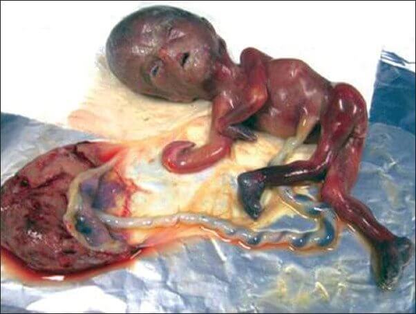 The-terminated-pregnancy-showing-different-abnormalities