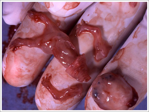 aborto2